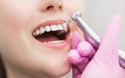 ¿Cómo se Hace un Blanqueamiento Dental y Cuándo es Conveniente?